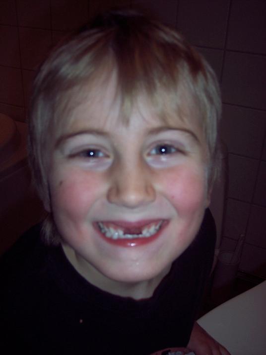 Victor med glugg efter nytappad tand